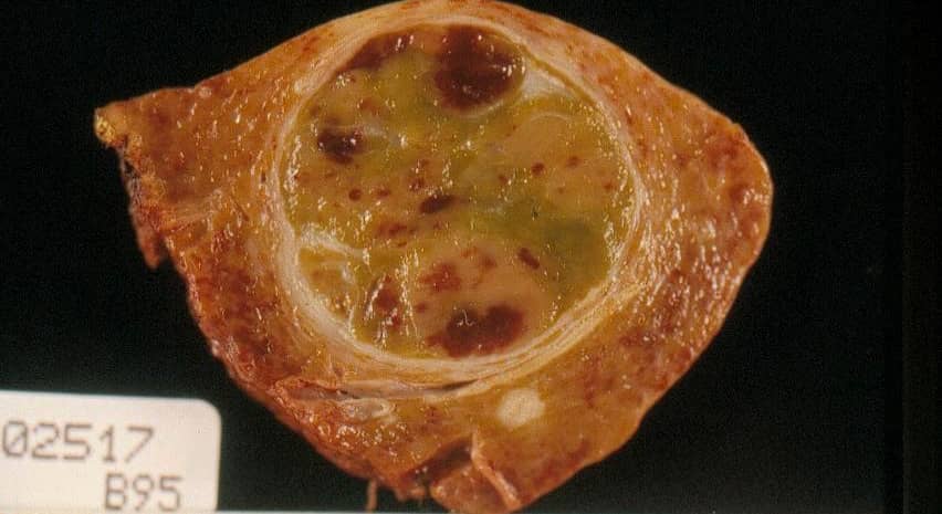 <hr>Coupe de carcinome hépatocellulaire (HC). © CHU de Rennes, B. Turlin.