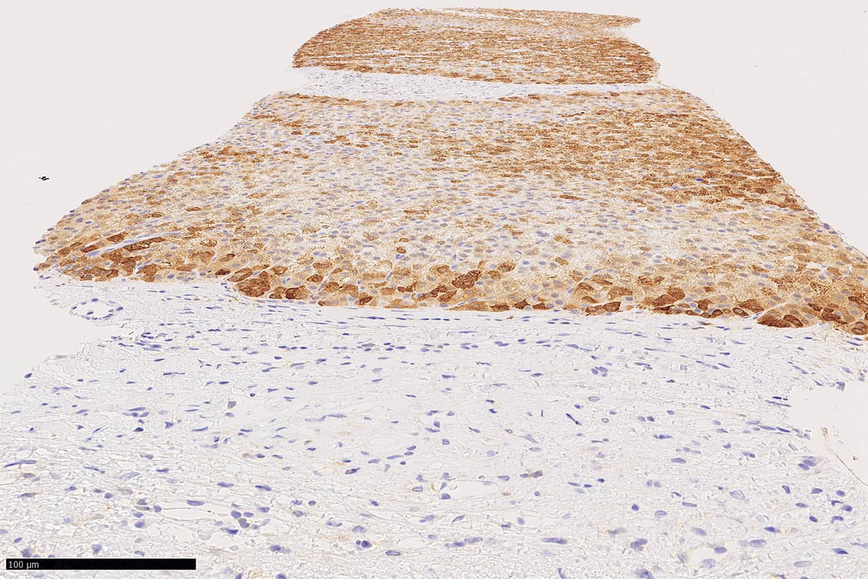 <hr>Aspect microscopique d’une tumeur hépatique avec marquage immunohistochimique par la glutamine synthétase.