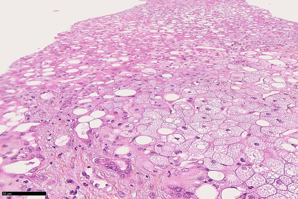 <hr>Biopsie hépatique en foie non tumoral : stéatose mixte micro et macro-vacuolaire.