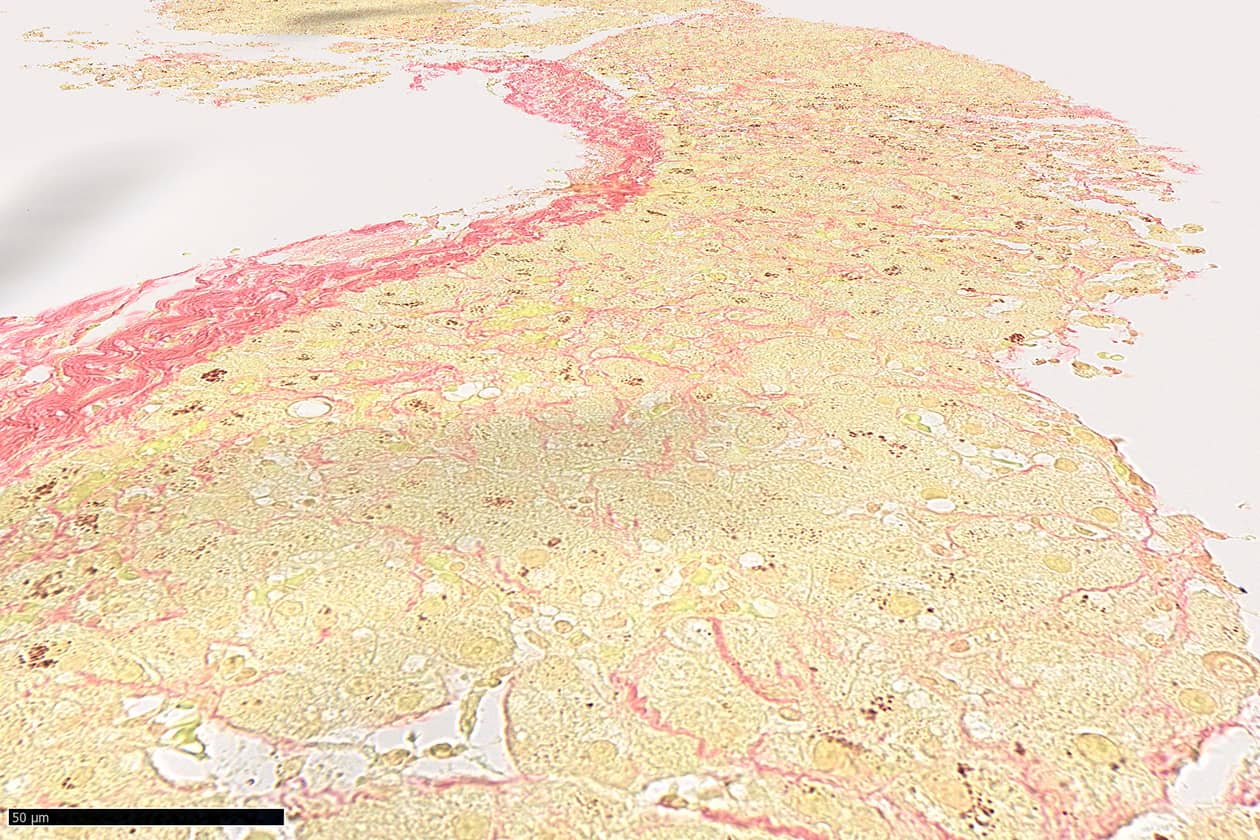 <hr>Biopsie hépatique avec coloration de la fibrose par le rouge Picro-Sirius.