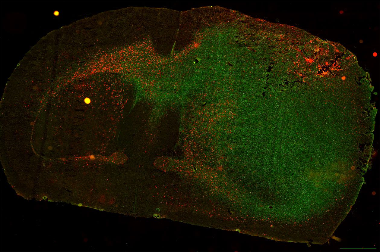 <hr>Immunofluorescence d’un glioblastome infiltrant (en vert) et de microglies/macrophages (en rouge) sur une coupe coronale du cerveau de souris.