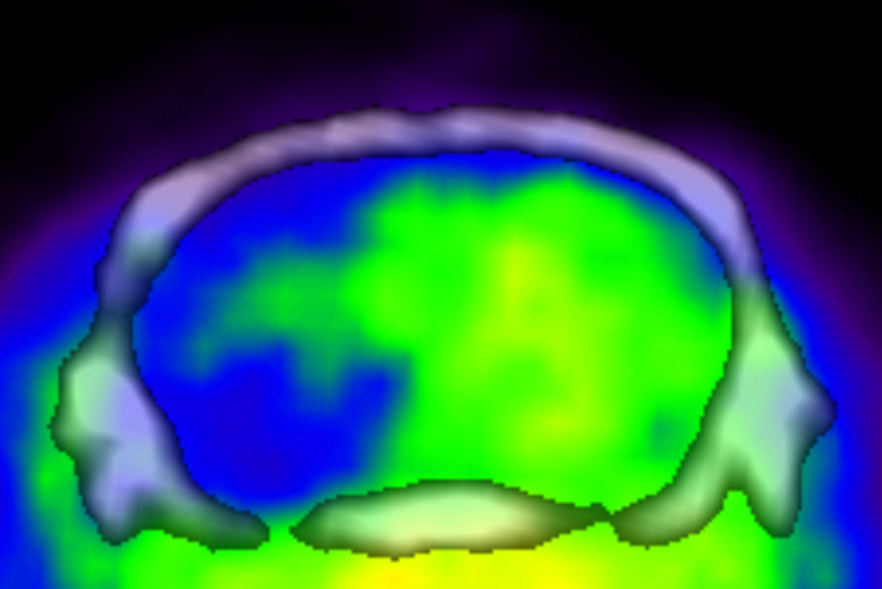<hr>Image TEP-TDM d’un glioblastome infiltrant, vue coronale d’un cerveau de souris.