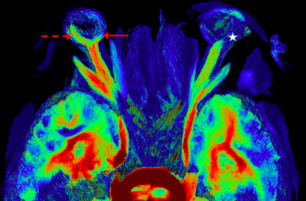 <hr>Tractographie chez des patients porteurs de Neuropathie optique ischémique antérieure (NOIA). © A. Attyé.