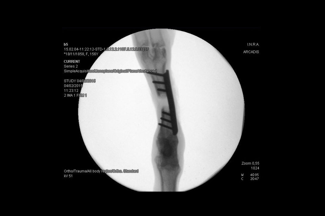 <hr>Visualisation sous amplificateur de brillance d’un greffon et d’une broche sur une patte de brebis.
