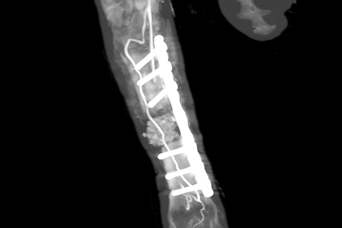 <hr>Visualisation par CT-scan de la néovascularisation d’un greffon (biomatériau) sur une patte de brebis.