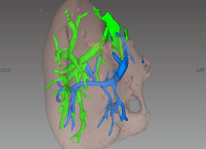 <hr>Utilisation d’un logiciel pour quantifier le volume du foie chez un porcelet après hépatectomie partielle et visualisation de la veine porte (bleu) et sus-hépatique (vert) après acquisition au CT-scan.