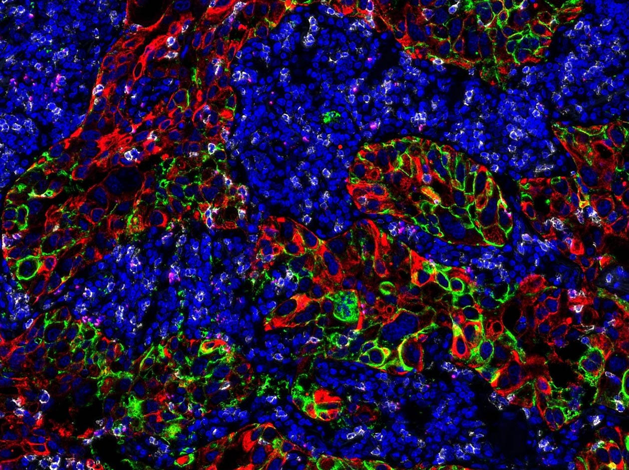 <hr>Immunofluorescence multiplexe. PDL1 (vert), PanCK (rouge), CD8 (blanc), PD1 (rose). 3DHisTech Pannoramic 250.