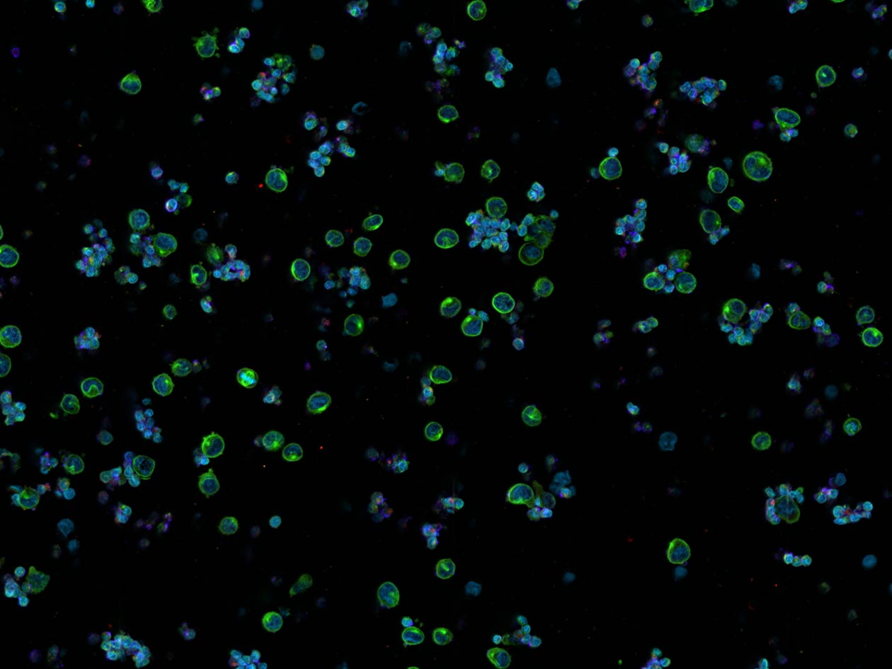 <hr>Mélanomes et CTLs. Tubuline (vert), CD8 (bleu), perforine (violet). 3DHisTech Pannoramic Confocal.