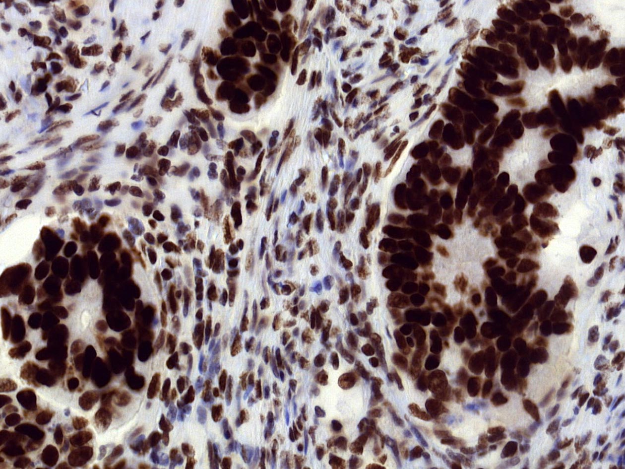 <hr>IHC MSH2 (Agilent AS48). 3DHisTech Pannoramic 250.