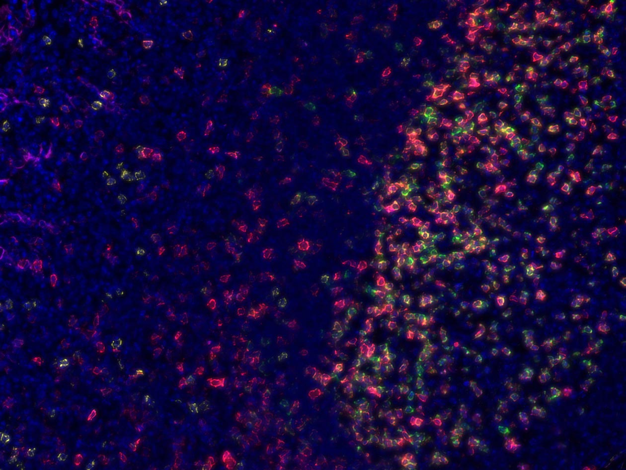 <hr>Immunofluorescence multiplexe. PD1 (vert), ICOS (rouge), CD8 (orange), PDL1 (rose). 3DHisTech Pannoramic 250.