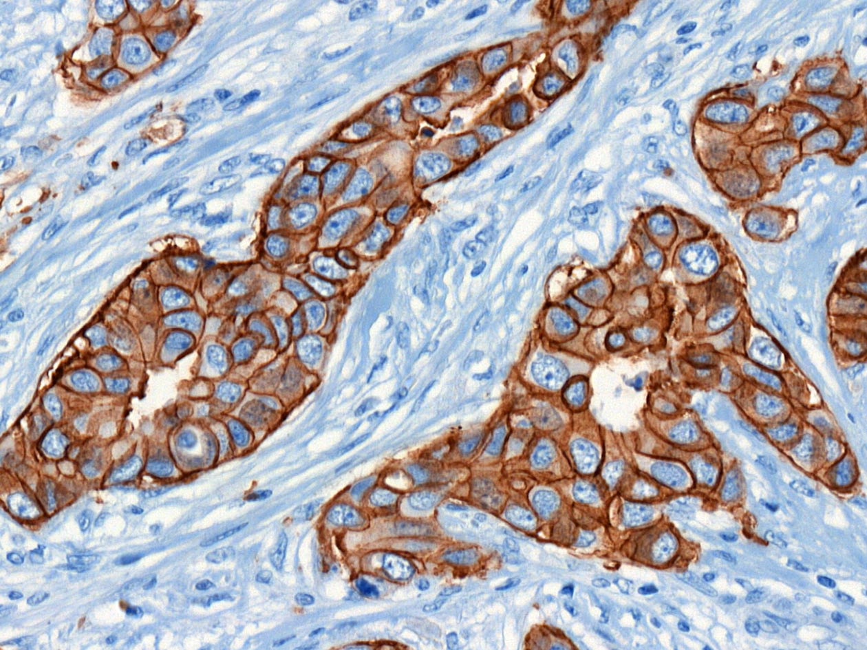 <hr>IHC HER2 (Roche/Ventana Benchmark Ultra). 3DHisTech Pannoramic 250.