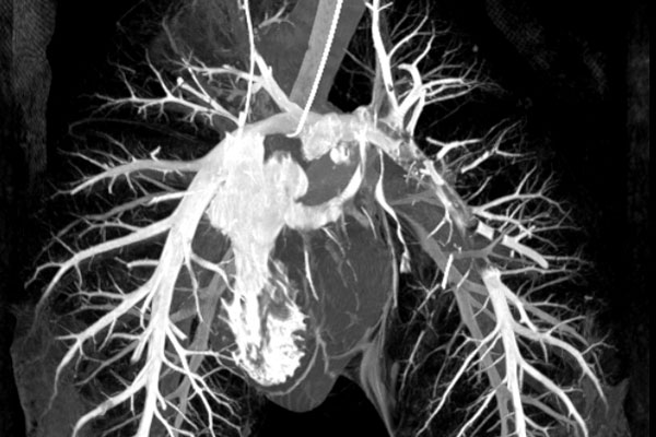 <hr>MIP coronal de l’arbre artériel pulmonaire porcin.