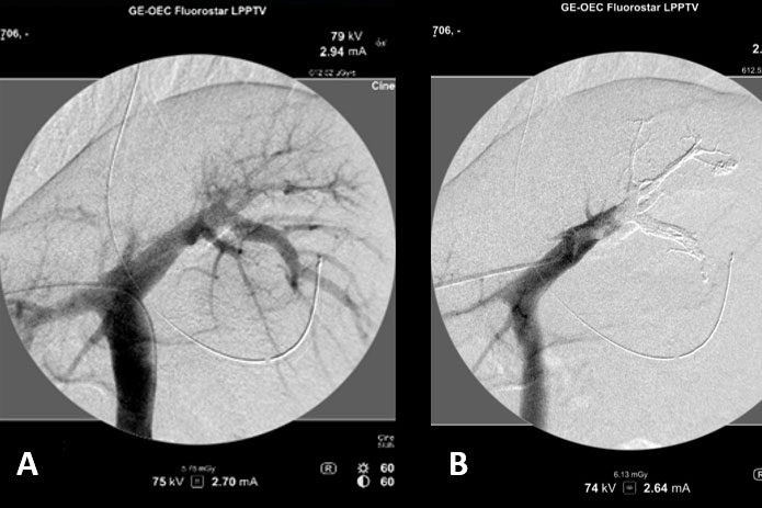 <hr>Portographie per (A) et post (B) embolisation sur un modèle porcin.
