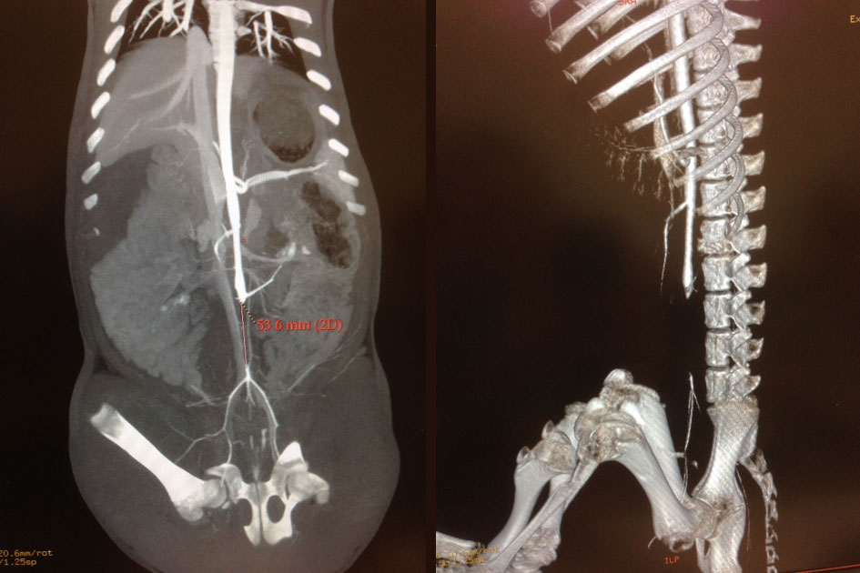 <hr>Mise en évidence d'une thrombose aortique par scanner (porc).