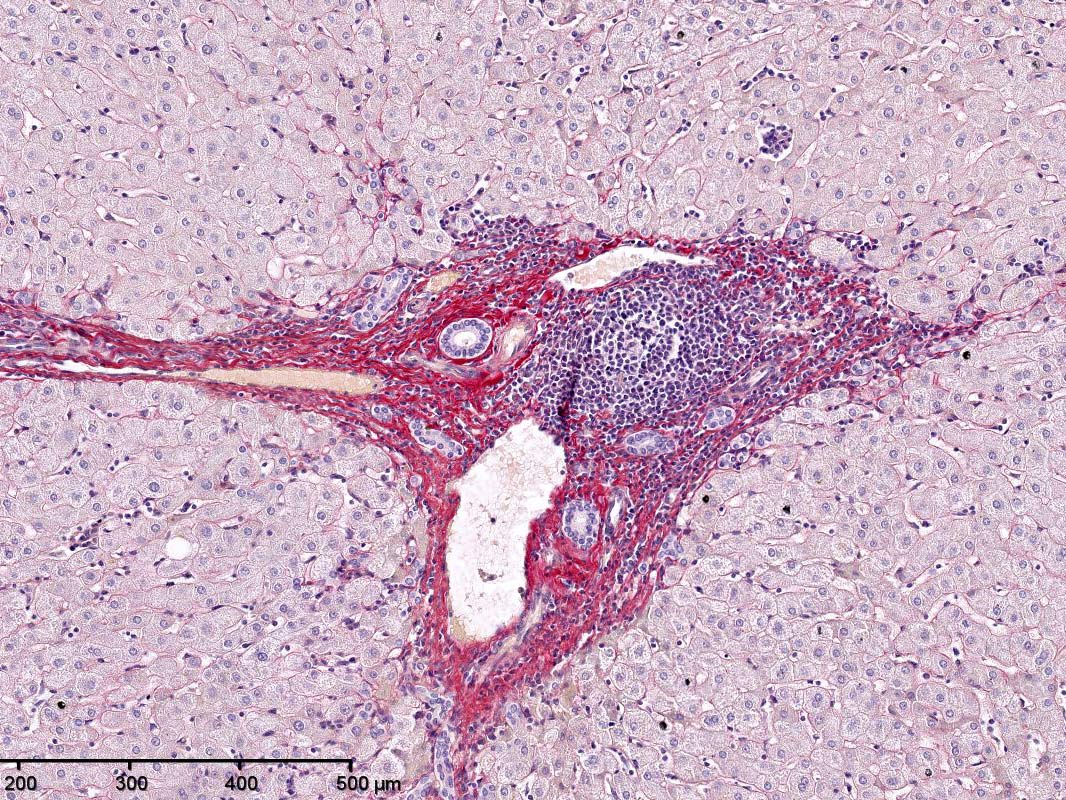 <hr>Caractérisation de la fibrose par coloration du collagène au rouge sirius dans un espace porte hépatique.