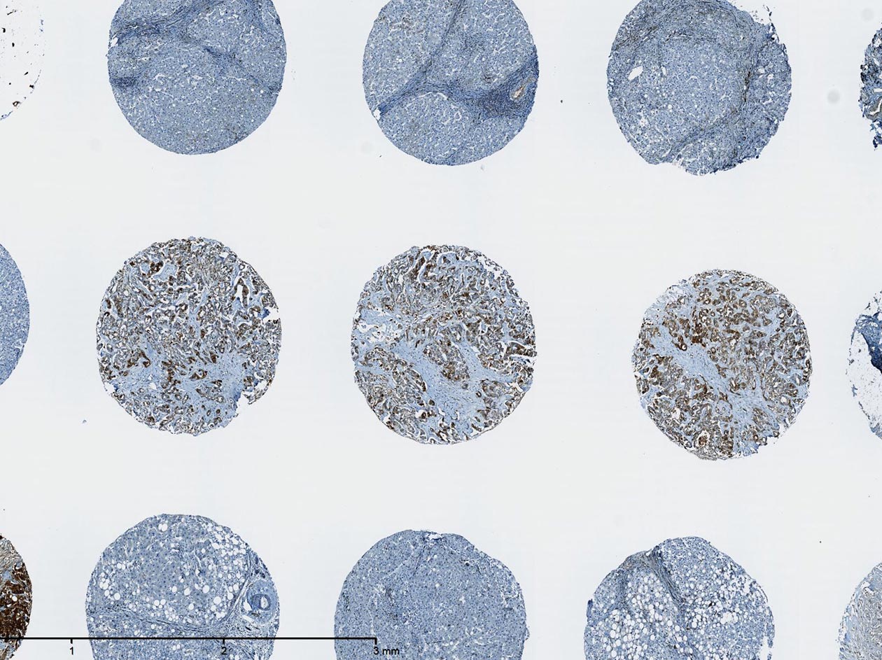 <hr>IHC anti-spp1 sur un TMA de 100 spots de cholangiocarcinomes.