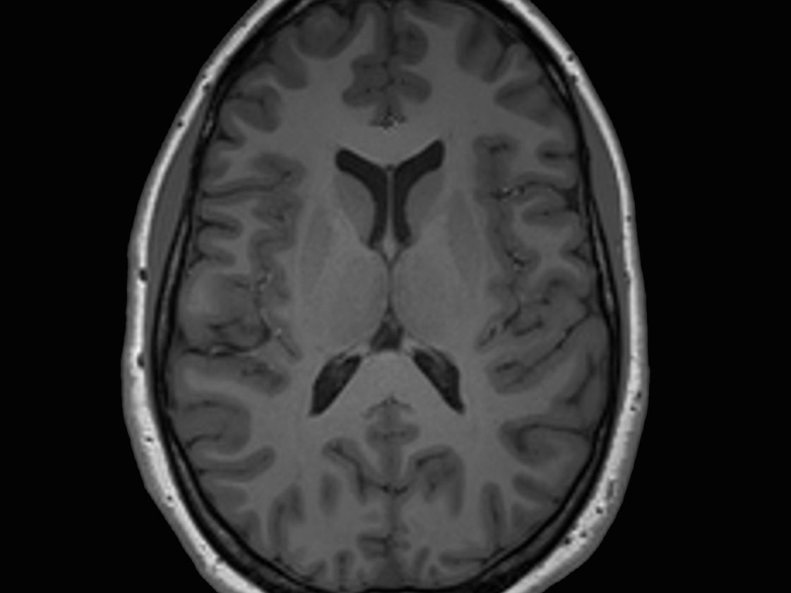 <hr>Image cérébrale morphologique.
