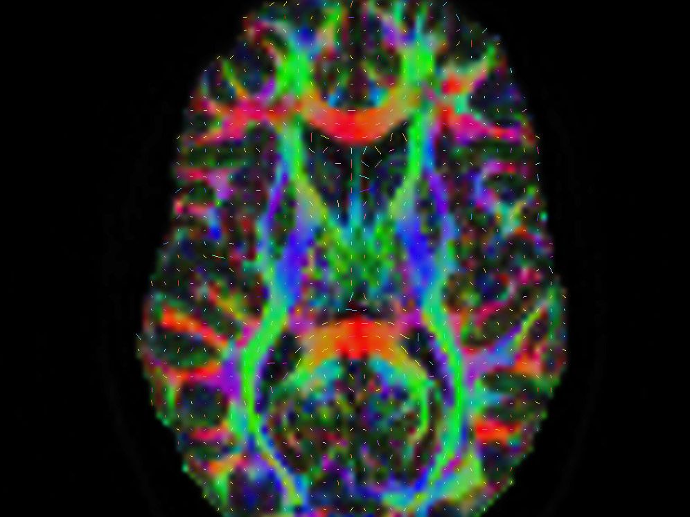 <hr>Imagerie cérébrale de diffusion : carte d'anisotropie fractionnelle.