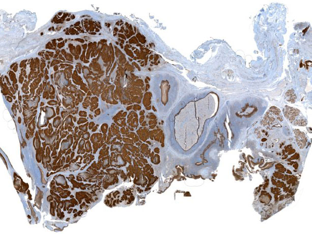 <hr>Lame virtuelle illustrant un marquage de la vimentine sur une coupe de tissu tumoral pulmonaire.