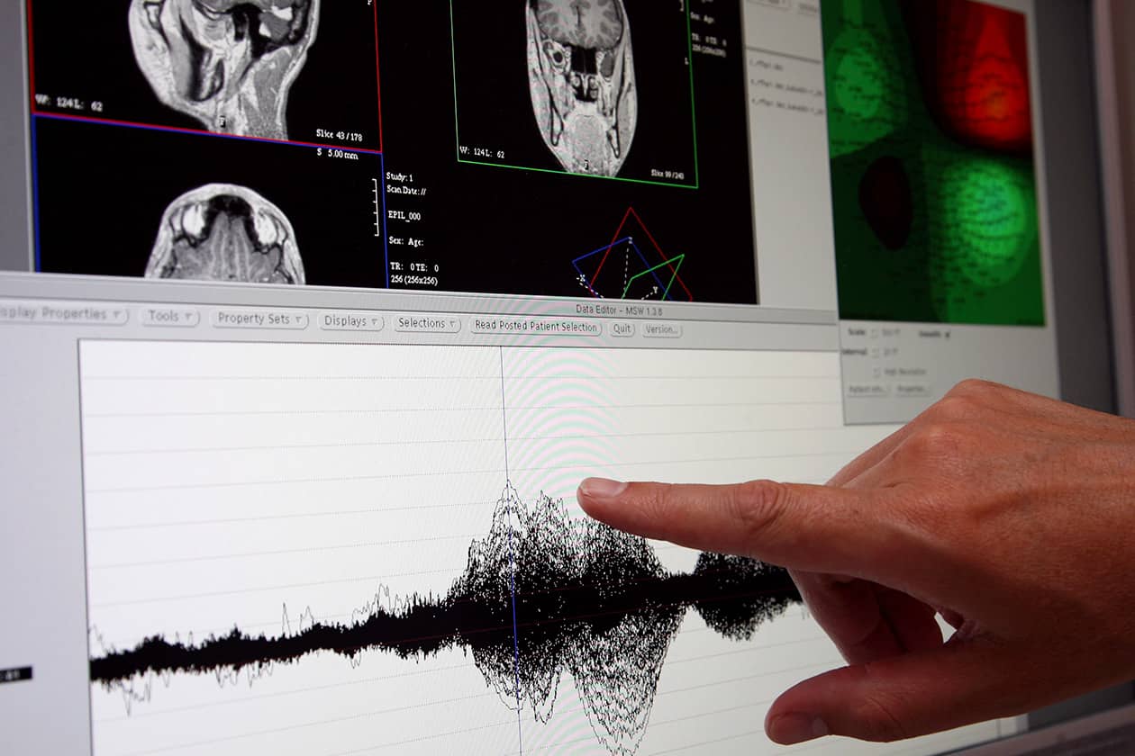 <hr>Analyse de réponses MEG évoquées par stimulation auditive. © AP-HM.