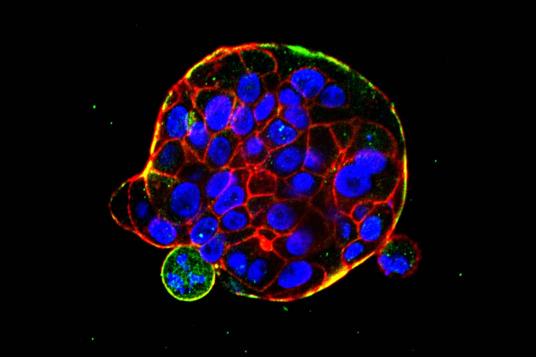 <hr>Groupe de cellules cancéreuses colorectales (HT29-MTX). Phalloïdine (vert), myosine (rouge), noyaux (bleu). © M. Lebel.