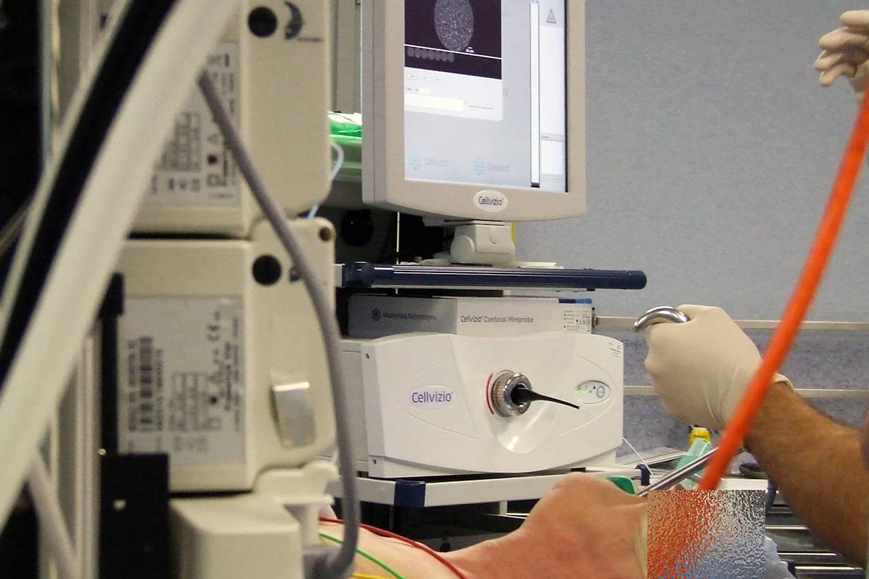 <hr>Patient présentant un cancer de la cavité buccale imagé in vivo par endomicroscopie.