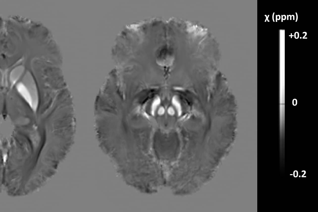<hr>Imagerie de susceptibilité pour la quantification du fer dans les noyaux gris centraux chez les patients de la cohorte Fair-Park II après 36 semaines de défériprone.