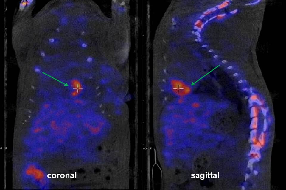 <hr>Modèle d’ischémie-reperfusion myocardique en SPECT/CT. La flèche montre une hyperfixation du 99mTc-fucoïdane à l’apex du ventricule gauche.