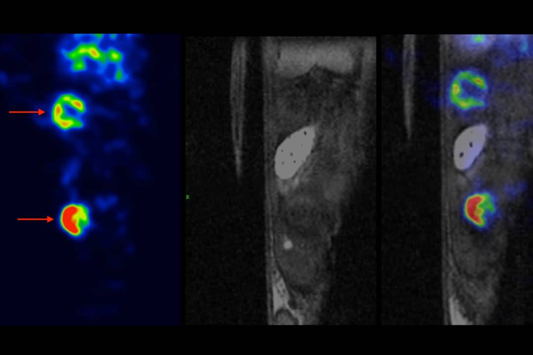 <hr>Suivi des polynucléaires marqués au technétium-99m dans un modèle murin d’infection de corps étranger en SPECT/IRM (recalage avec le logiciel PMOD).